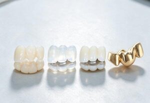 Dental Bridge Types and Materials: A Comprehensive Clinical Reference